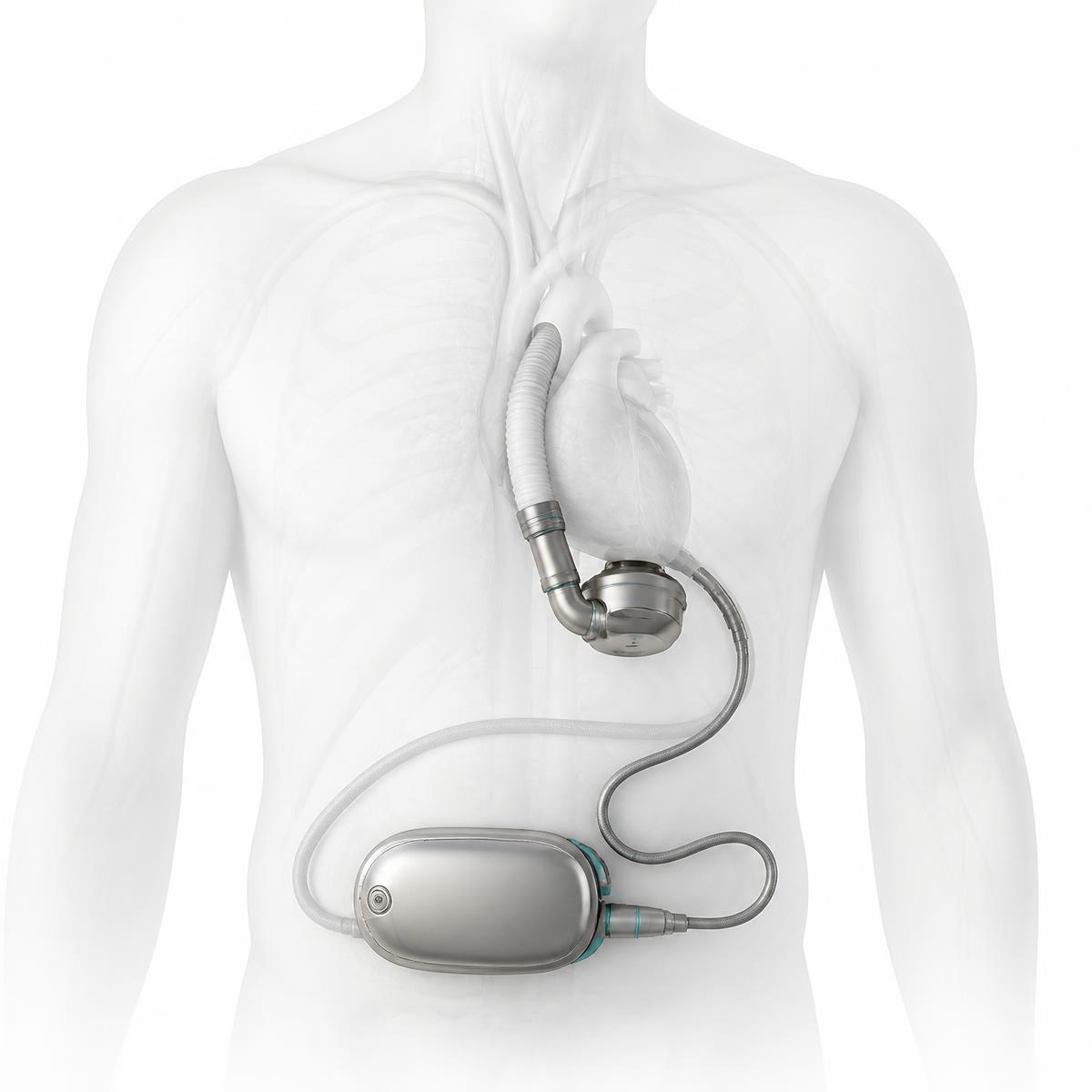 Blood & heart-replacement pumps